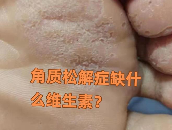 维生素B3缺乏皮肤问题_怎么补充维生素b3_长期缺乏维生素B3人群